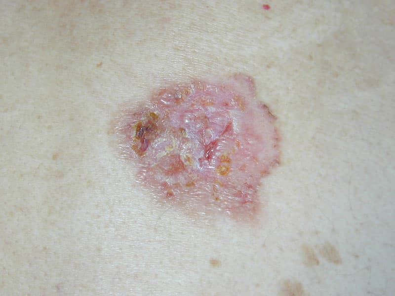Tumor de piel